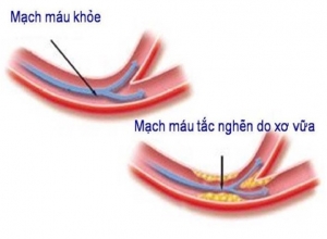 Bệnh tiểu đường (Đái tháo đường) gây nên biến chứng mạch máu lớn